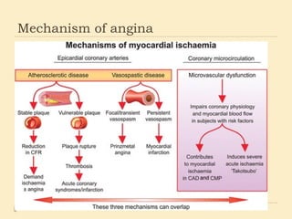 REFRACTORY ANGINA....................pptx