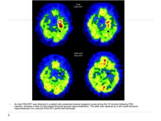 An ictal FDG-PET was obtained in a patient who presented several epigastric auras during the 10 minutes following FDG injection, showing a clear-cut left mesial temporal glucose hypermetabolism. The latter was replaced by a left mesial temporal hypometabolism on a second FDG-PET performed interictally.