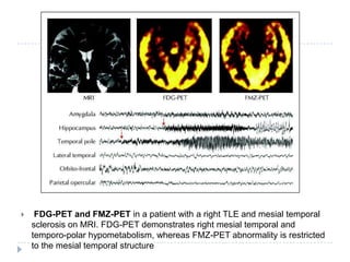  FDG-PET and FMZ-PET in a patient with a right TLE and mesial temporal sclerosis on MRI. FDG-PET demonstrates right mesial temporal and temporo-polar hypometabolism, whereas FMZ-PET abnormality is restricted to the mesial temporal structure