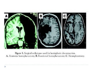 Cerebral hemispherectomy or hemispherotomyIt should be considered in patients where seizure focus is limited to one hemisphere and patient already has disabling hemiparesis with useless hand. It has been reported to decrease seizure frequency and improve developmental quotient in children with catastrophic hemispheric epilepsy of diverse aetiologies such as malformations of cortical development, Rasmussen’s encephalitis, Sturge-Weber syndrome, and remote vascular insults.