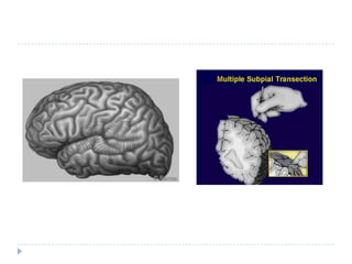 Multiple subpialtransections (MST)MST may be an option for patients with RE whose seizures begin in areas of the brain that cannot be safely removed. In addition, there must be a reasonable chance that the person will benefit from surgery. MST stops the seizure impulses by cutting nerve fibers in the grey matter of the brain sparing the vital functions concentrated in white matter. It is reported to achieve a significant seizure reduction