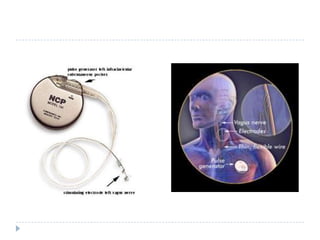 Vagal nerve stimulation (VNS)This is indicated in adults with RE in whom definitive surgery is not possible or who had undergone surgery without success. VNS uses an implanted stimulator that sends electric impulses to the left vagal nerve in the neck via a lead wire implanted under the skin. A 50% reduction in seizure frequency has been reported in about one-third of patients. However, seizure freedom is rare