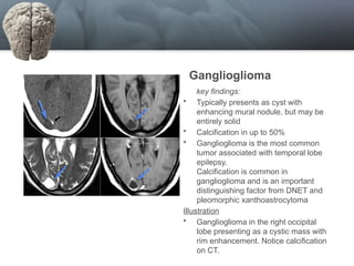 Navigating Refractory Epilepsy: Clinical Challenges, Neuroimaging, and ...