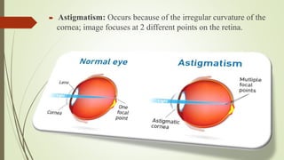  Astigmatism: Occurs because of the irregular curvature of the
cornea; image focuses at 2 different points on the retina.
 
