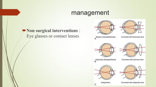 management
Non surgical interventions :
Eye glasses or contact lenses
 
