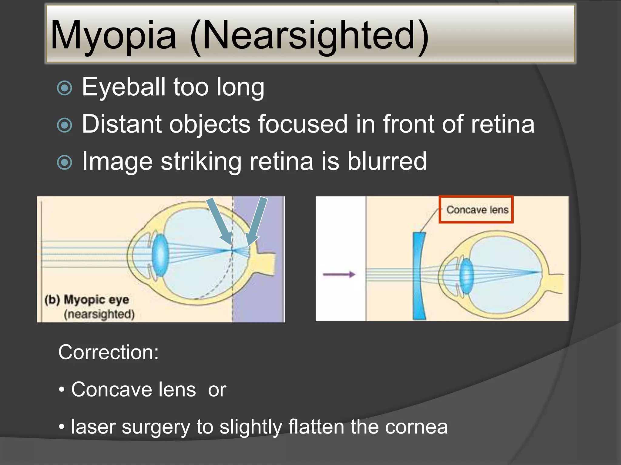 Myopia (Nearsighted)
 Eyeball too long
 Distant objects focused in front of retina
 Image striking retina is blurred
Correction:
• Concave lens or
• laser surgery to slightly flatten the cornea
 