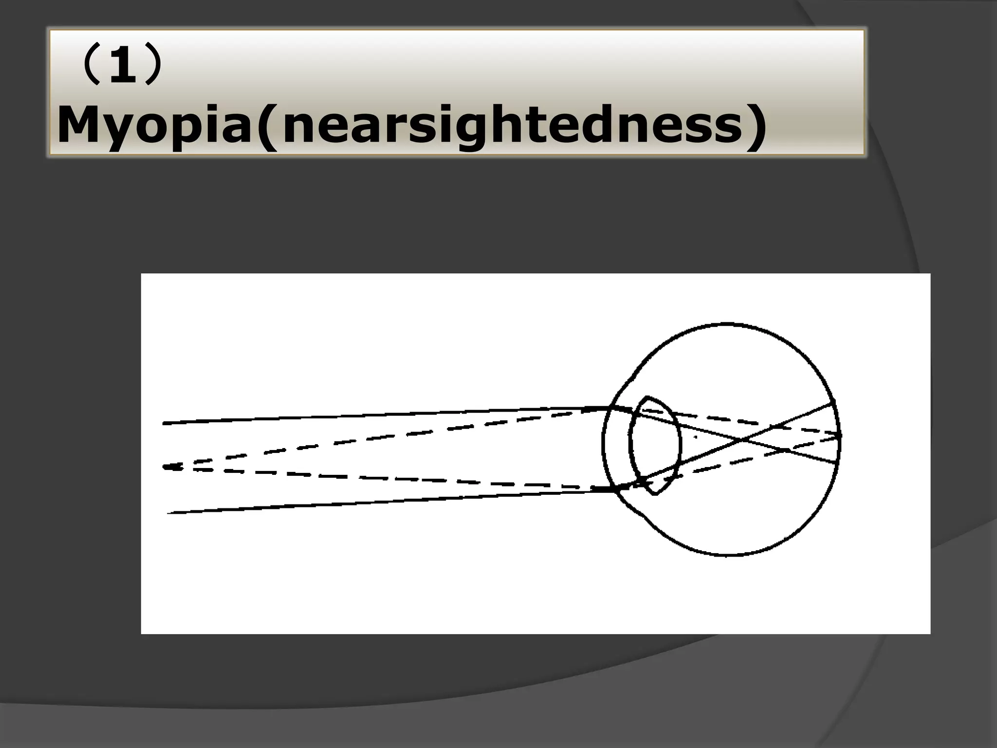 （1）
Myopia(nearsightedness)
 