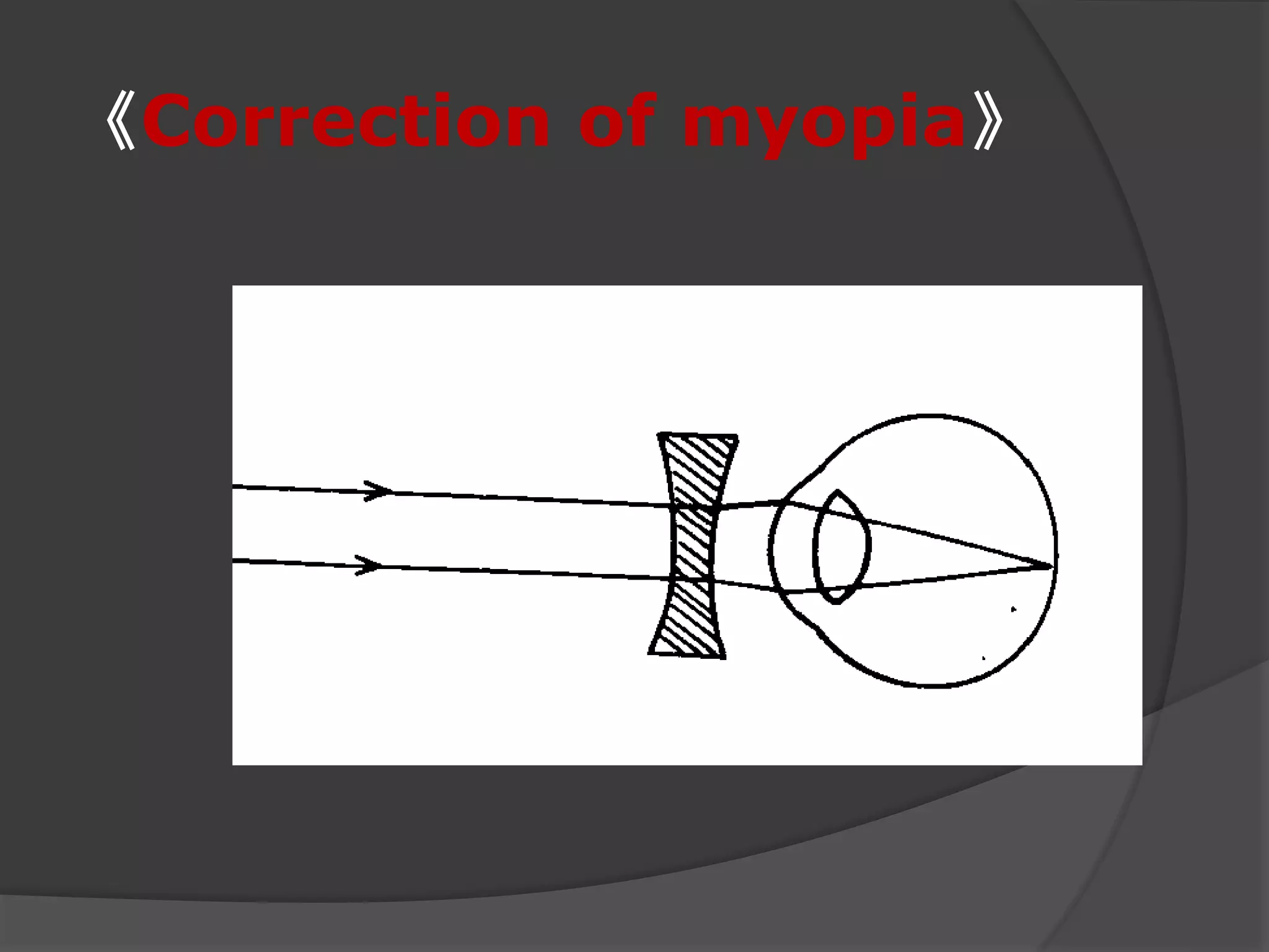《Correction of myopia》
 