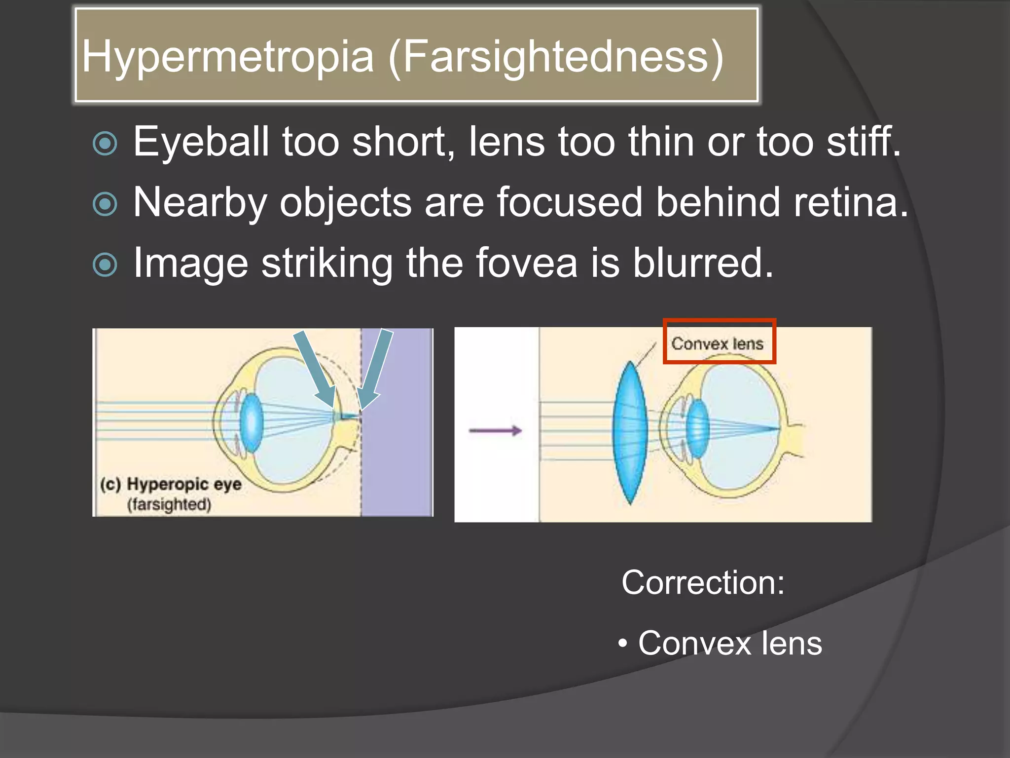 Hypermetropia (Farsightedness)
 Eyeball too short, lens too thin or too stiff.
 Nearby objects are focused behind retina.
 Image striking the fovea is blurred.
Correction:
• Convex lens
 