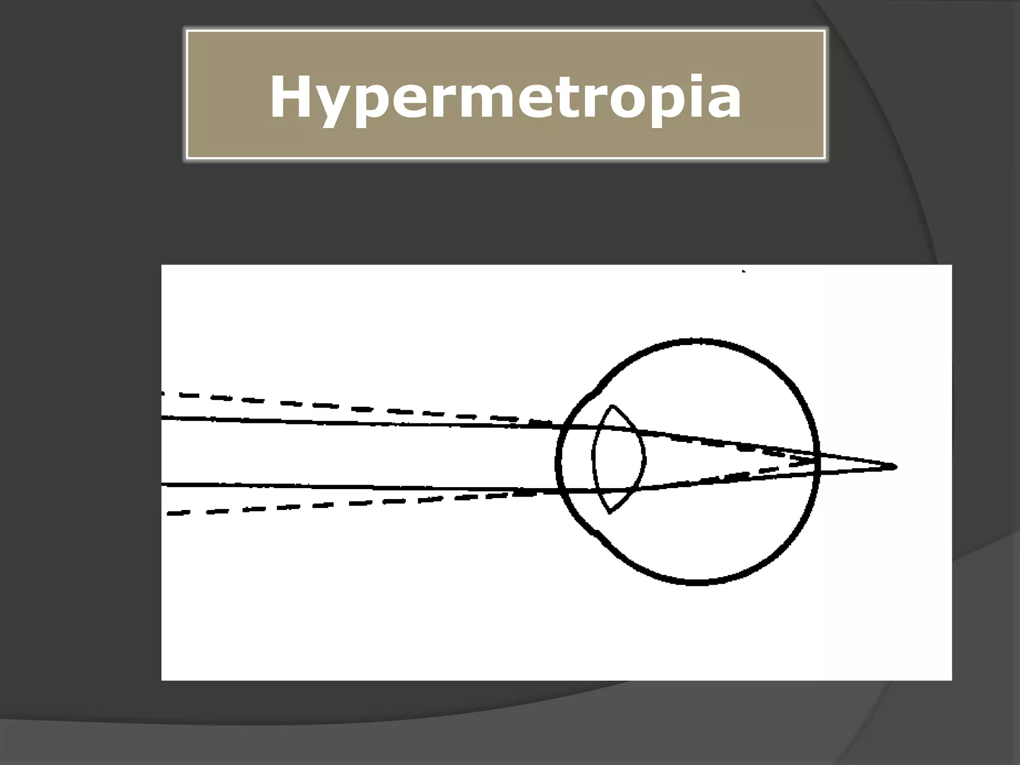 Hypermetropia
 
