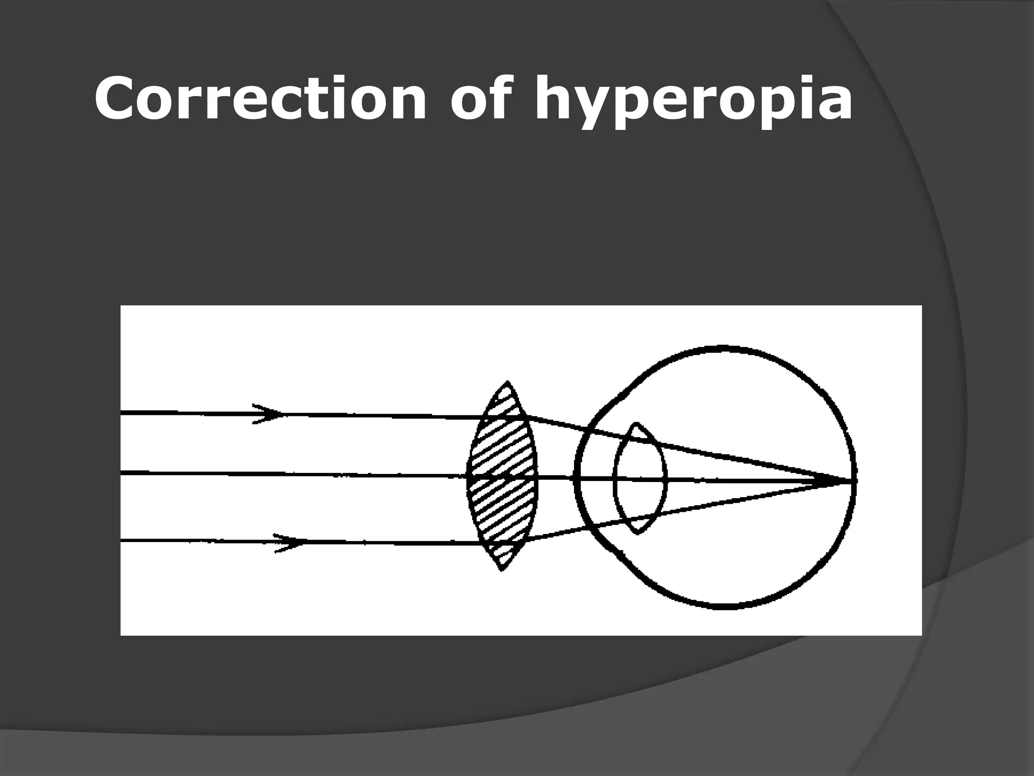 Correction of hyperopia
 