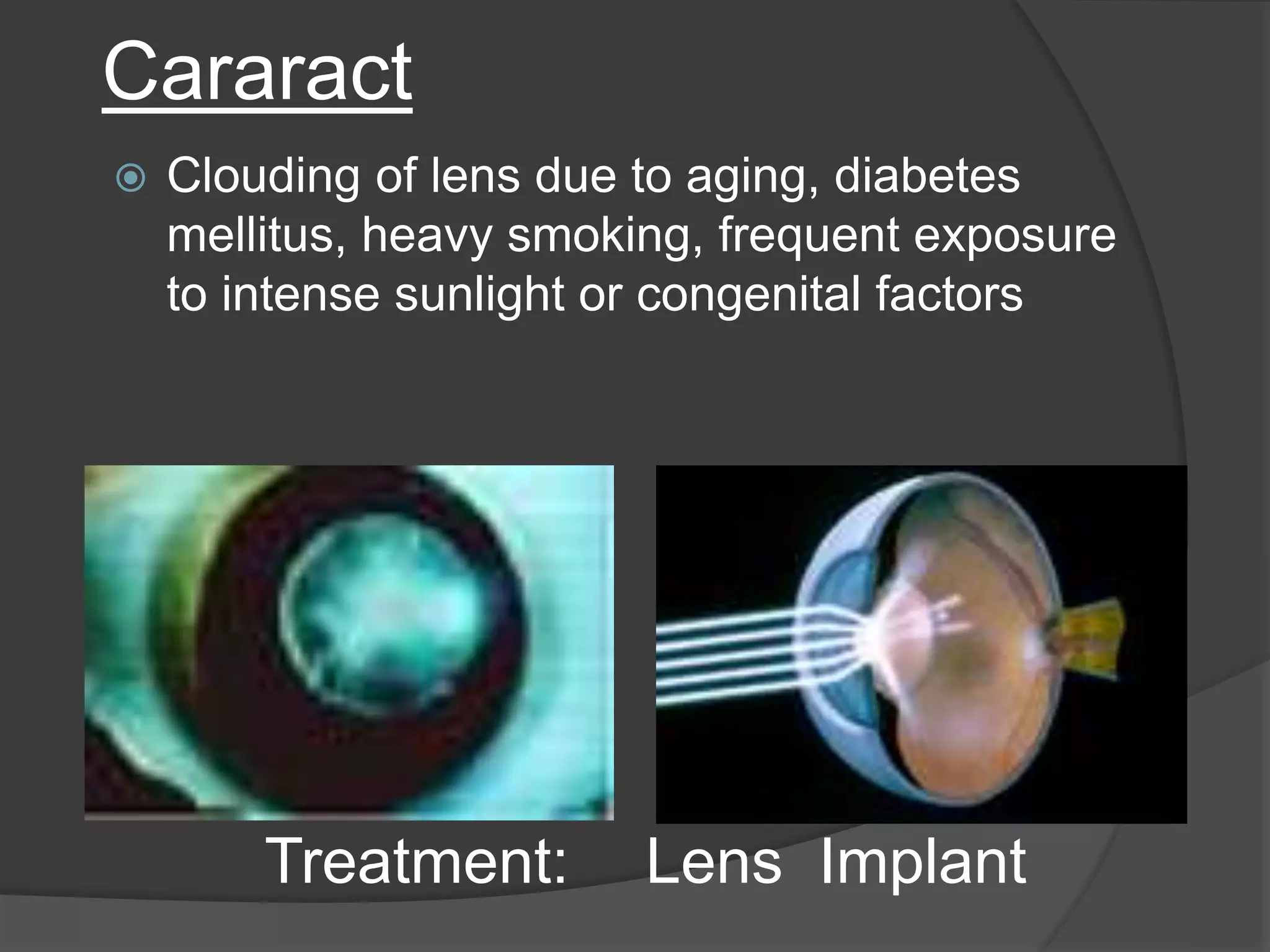 Cararact
 Clouding of lens due to aging, diabetes
mellitus, heavy smoking, frequent exposure
to intense sunlight or congenital factors
Treatment: Lens Implant
 