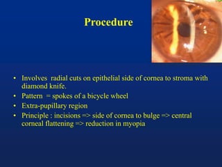 Procedure
• Involves radial cuts on epithelial side of cornea to stroma with
diamond knife.
• Pattern = spokes of a bicycle wheel
• Extra-pupillary region
• Principle : incisions => side of cornea to bulge => central
corneal flattening => reduction in myopia
 
