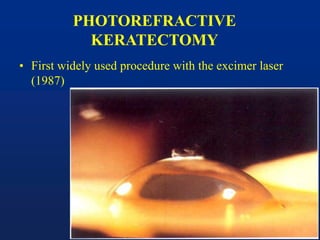 PHOTOREFRACTIVE
KERATECTOMY
• First widely used procedure with the excimer laser
(1987)
 