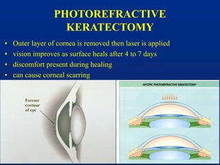 PHOTOREFRACTIVE
KERATECTOMY
• Outer layer of cornea is removed then laser is applied
• vision improves as surface heals after 4 to 7 days
• discomfort present during healing
• can cause corneal scarring
 