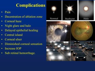 Complications
• Pain
• Decentration of ablation zone
• Corneal haze
• Night glare and halo
• Delayed epithelial healing
• Central island
• Corneal ulser
• Diminished corneal sensation
• Increase IOP
• Sub retinal hemorrhage.
 