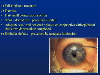 4) Full thickness resection
5) Free cap –
• Flat/ small cornea, poor suction
• Small / decentered : procedure aborted
• Adequate size/ well centered : placed on conjunctiva with epithelial
side down & procedure completed
6) Epithelial defects – prevented by adequate lubrication
 