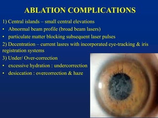 ABLATION COMPLICATIONS
1) Central islands – small central elevations
• Abnormal beam profile (broad beam lasers)
• particulate matter blocking subsequent laser pulses
2) Decentration – current lasres with incorporated eye-tracking & iris
registration systems
3) Under/ Over-correction
• excessive hydration : undercorrection
• desiccation : overcorrection & haze
 