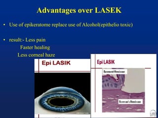 Advantages over LASEK
• Use of epikeratome replace use of Alcohol(epithelio toxic)
• result:- Less pain
Faster healing
Less corneal haze
 