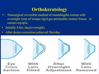 Orthokeratology
• Nonsurgical reversible method of mouldingthe cornea with
overnight wear of unique rigid gas permeable contact lenses to
correct myopia.
• Initially 8 hrs./day(overnight)
• After desire correction achieved 3hrs/day
 