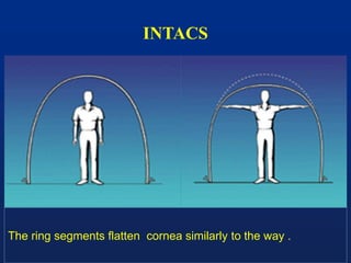 INTACS
The ring segments flatten cornea similarly to the way .
 