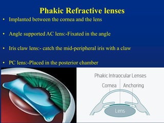 Phakic Refractive lenses
• Implanted between the cornea and the lens
• Angle supported AC lens:-Fixated in the angle
• Iris claw lens:- catch the mid-peripheral iris with a claw
• PC lens:-Placed in the posterior chamber
 