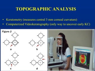 TOPOGRAPHIC ANALYSIS
• Keratometry (measures central 3 mm corneal curvature)
• Computerized Videokeratography (only way to uncover early KC)
 
