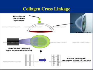 Collagen Cross Linkage
 