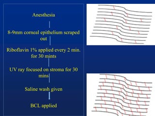 Anesthesia
8-9mm corneal epithelium scraped
out
Riboflavin 1% applied every 2 min.
for 30 mints
UV ray focused on stroma for 30
mins
Saline wash given
BCL applied
 