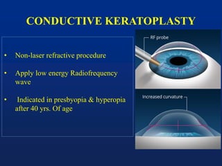 CONDUCTIVE KERATOPLASTY
• Non-laser refractive procedure
• Apply low energy Radiofrequency
wave
• Indicated in presbyopia & hyperopia
after 40 yrs. Of age
 