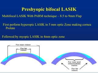 Presbyopic bifocal LASIK
Multifocal LASIK With PARM technique – 8.5 to 9mm Flap
First perform hyperopic LASIK in 5 mm optic Zone making cornea
Prolate
Followed by myopic LASIK in 4mm optic zone
 
