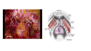 refreshed laparoscopic burch colposuspension.pptx