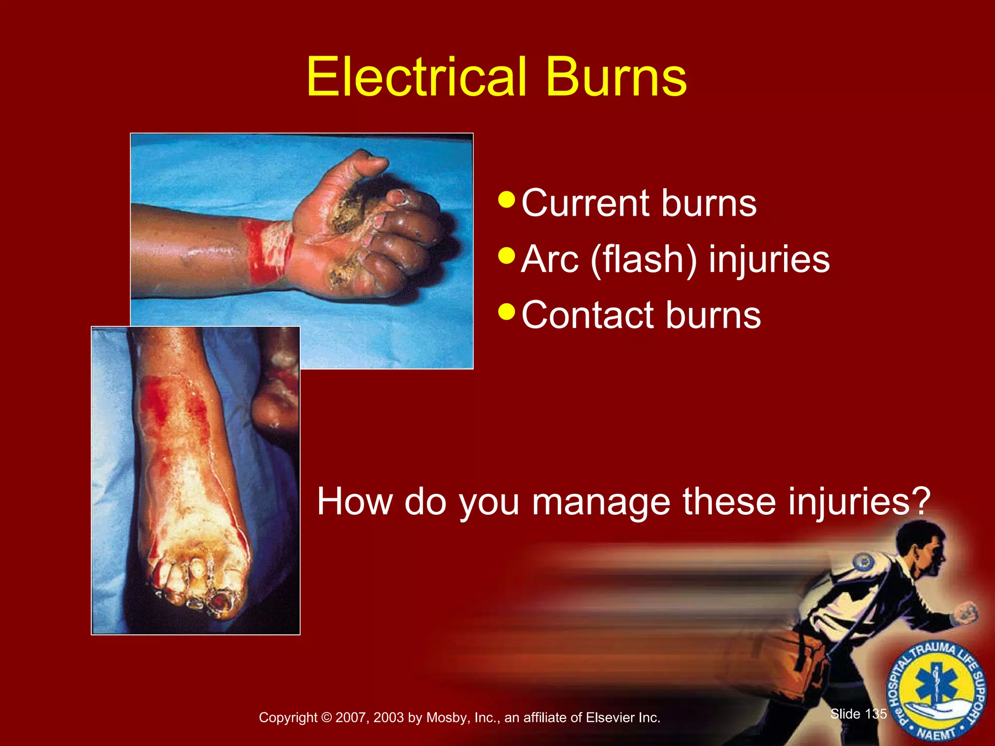 Electrical Burns Current burns Arc (flash) injuries Contact burns How do you manage these injuries? 
