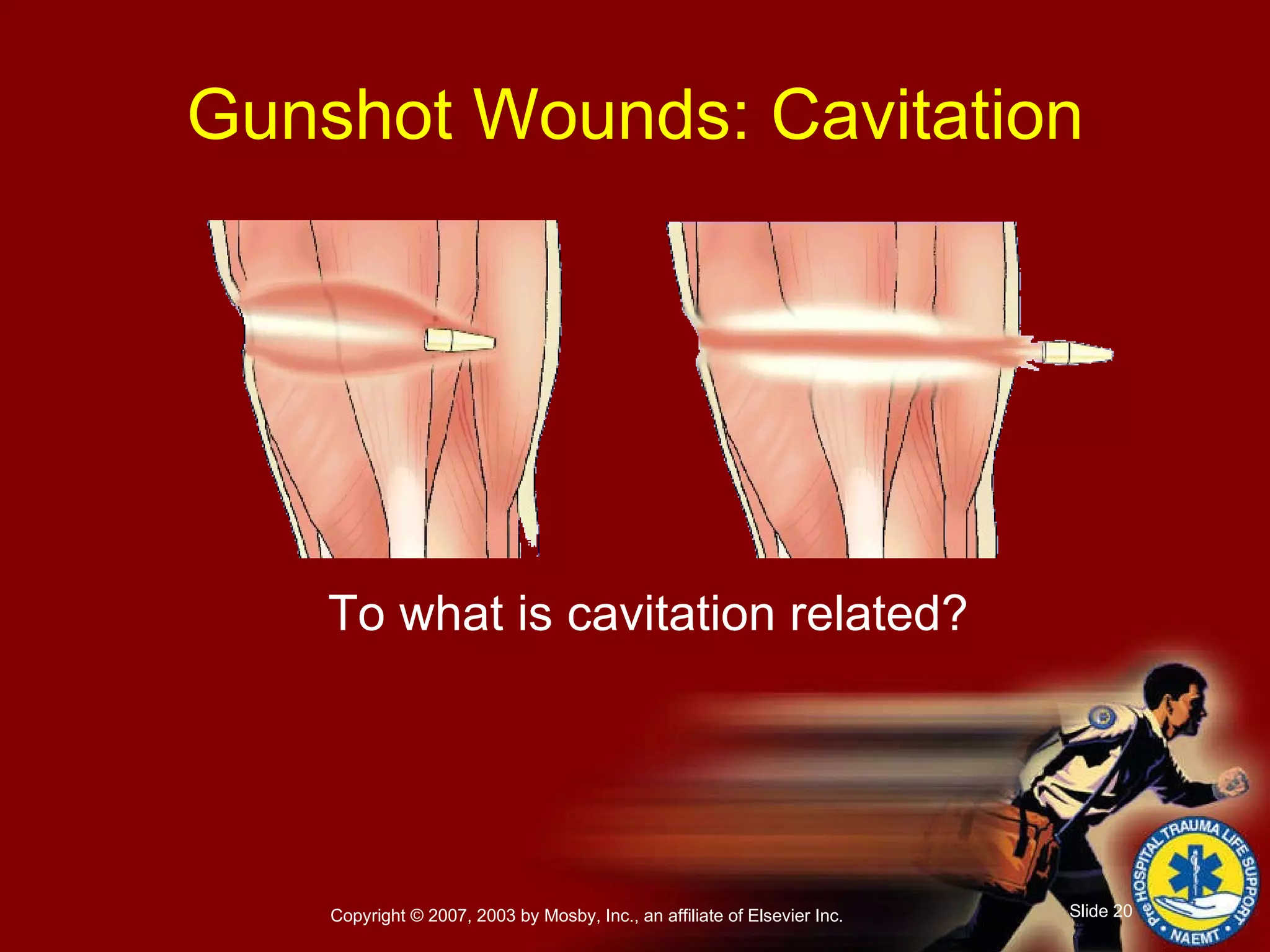 To what is cavitation related? Gunshot Wounds: Cavitation 