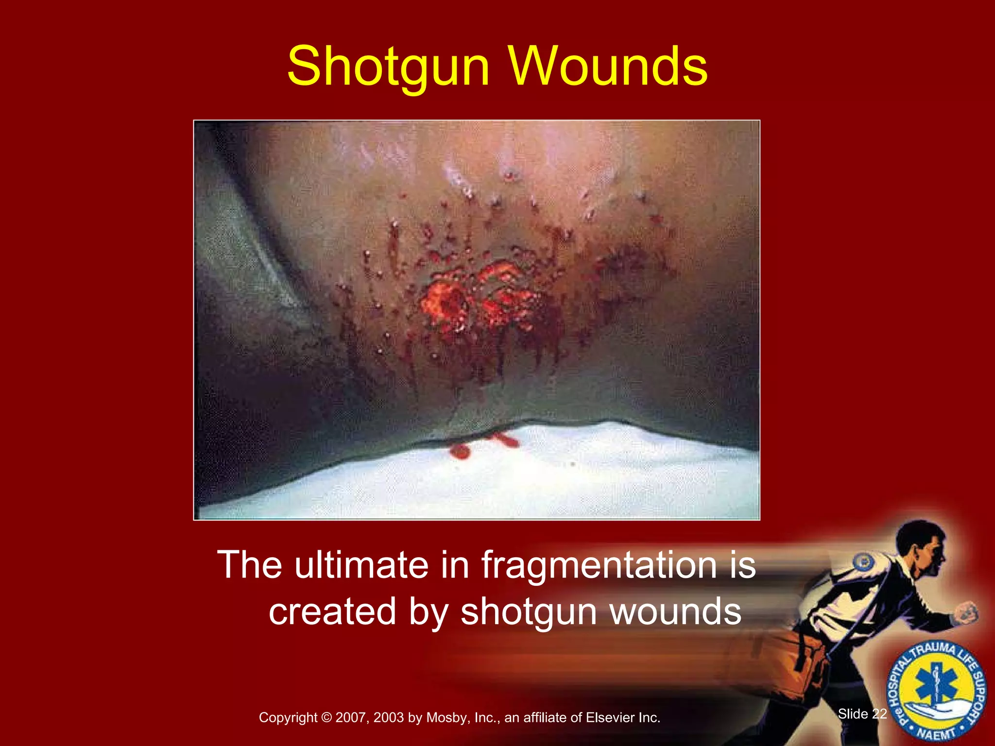 The ultimate in fragmentation is created by shotgun wounds Shotgun Wounds 