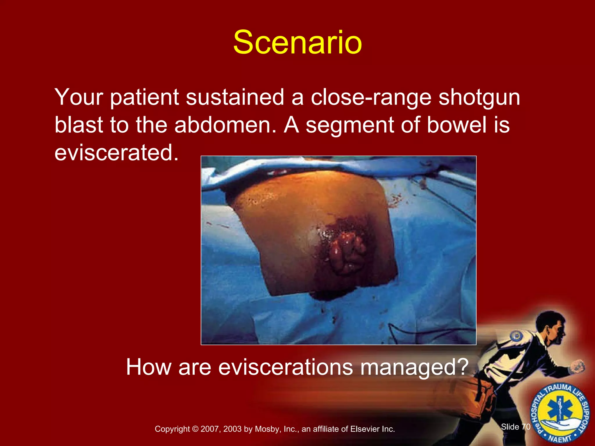 Your patient sustained a close-range shotgun blast to the abdomen. A segment of bowel is eviscerated. How are eviscerations managed? Scenario 