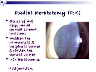 refractive surgeries | PPT