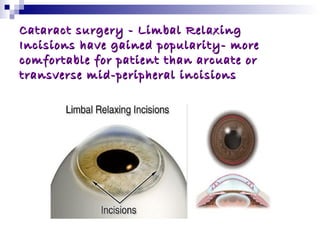 refractive surgeries | PPT