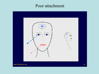 Poor attachment 