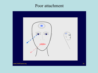 Poor attachment 