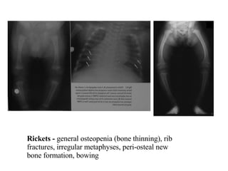 Rickets -  general osteopenia (bone thinning), rib fractures, irregular metaphyses, peri-osteal new bone formation, bowing 