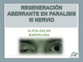 REGENERACIÓN ABERRANTE EN PARALISIS III NERVIO<br />ALICIA GALAN<br />BARCELONA<br />