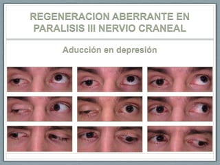 REGENERACION ABERRANTE EN PARALISIS III NERVIO CRANEAL<br />Aducción en depresión<br />