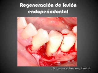 Regeneración de lesión
   endoperiodontal




            Dr. Latorre Valenzuela, Jose Luis
 
