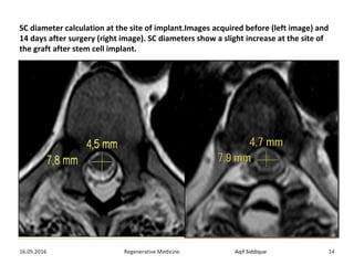 Aqif SiddiqueRegenerative Medicine16.05.2016 14
SC diameter calculation at the site of implant.Images acquired before (left image) and
14 days after surgery (right image). SC diameters show a slight increase at the site of
the graft after stem cell implant.
 