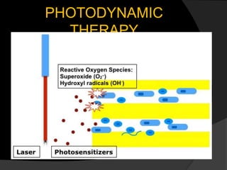 PHOTODYNAMIC
THERAPY
 