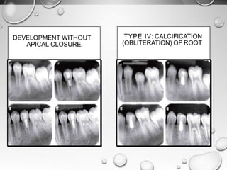 TYPE IV: CALCIFICATION
(OBLITERATION) OF ROOT
DEVELOPMENT WITHOUT
APICAL CLOSURE.
 