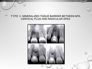 TYPE V: MINERALIZED TISSUE BARRIER BETWEEN MTA
CERVICAL PLUG AND RADICULAR APEX.
 