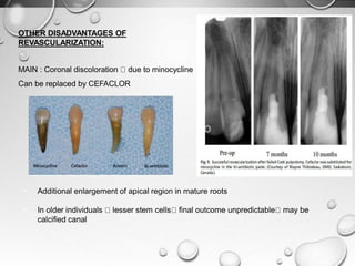OTHER DISADVANTAGES OF
REVASCULARIZATION:
MAIN : Coronal discoloration due to minocycline
Can be replaced by CEFACLOR
• Additional enlargement of apical region in mature roots
• In older individuals lesser stem cells final outcome unpredictable may be
calcified canal
 