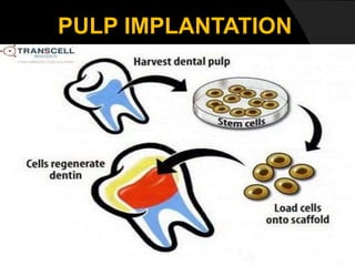 PULP IMPLANTATION
 